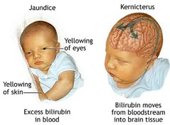 <p>Bilirubin in the bloodstream is too great and ends up in the brain tissue </p><p>Can cause permanent neural damage</p>