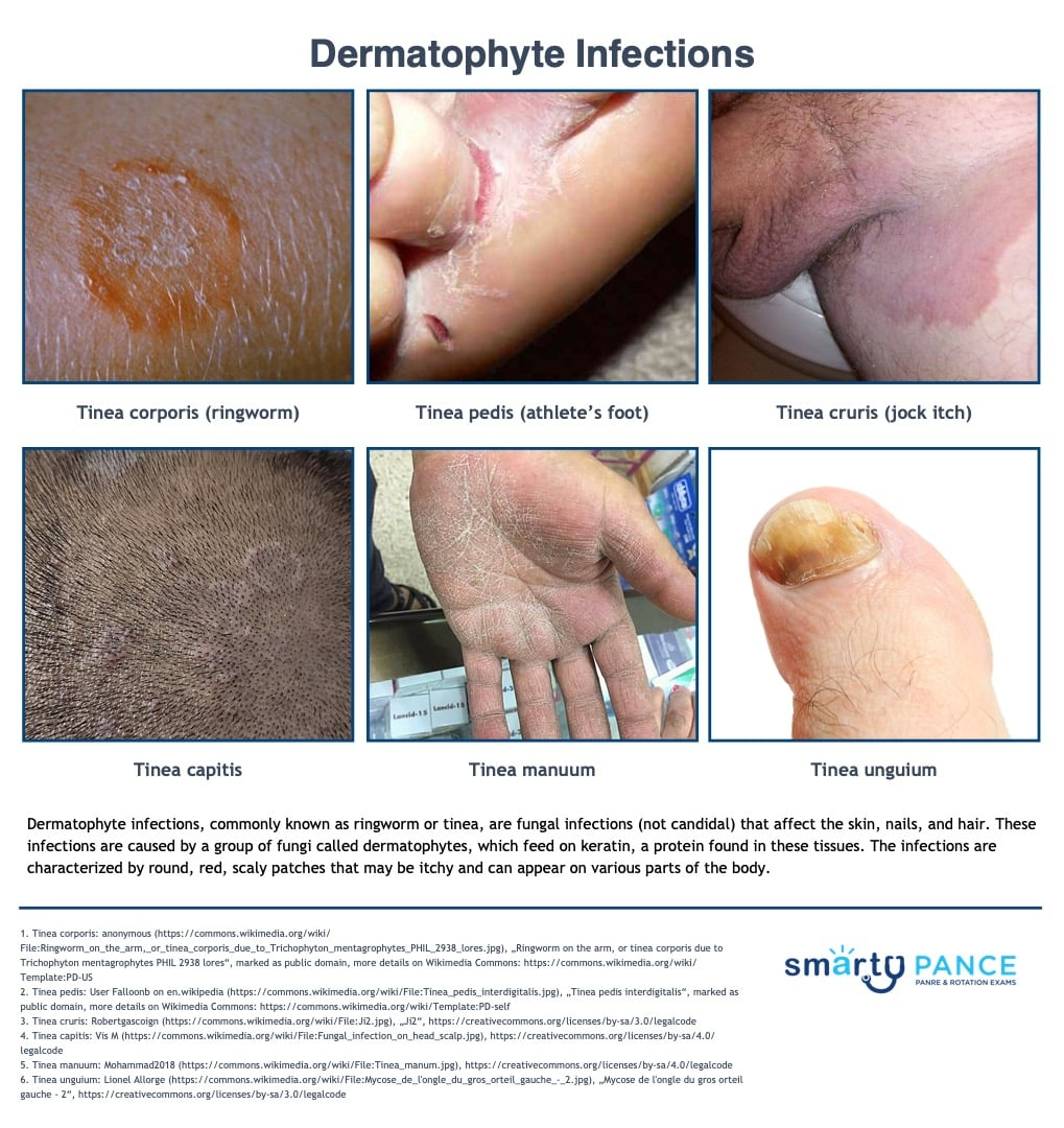<p>Tinea infection of the feet/toes</p><p>-Presentation: itchy-scaling between the toes </p><p>-Tx: topical azoles </p>
