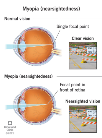 <p>nearsightedness </p><ul><li><p>see near objects clearly but objects that are farther away appear blurry </p></li><li><p>this occurs because the eye focuses light in front of the retina instead of directly on it </p></li><li><p>need negative power lens</p></li></ul><p></p>