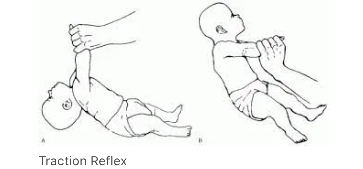 <p>elicited by pulling the baby up by their forearms into sitting (pull-to-sit), resulting in (1) head lag, then —> (2) baby flexing their head, *UEs, and *hands —> and (3) ending in a sitting position; importance is the enhanced *momentary reflexive grasp, preparing baby for voluntary control of grasping </p><ul><li><p>birth-6 months</p><ul><li><p>onset: 28 weeks gestation</p></li><li><p>integration: 2-5 months</p></li></ul></li><li><p>“pulling” is a form of “traction”; “traction of the neck” resulting in it —> “following the body into flexion”</p></li></ul><p></p>