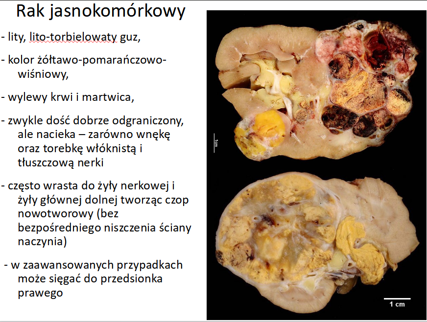 <p>e. Szybkie przerzuty do okołoaortalnych węzłów chłonnych.</p>
