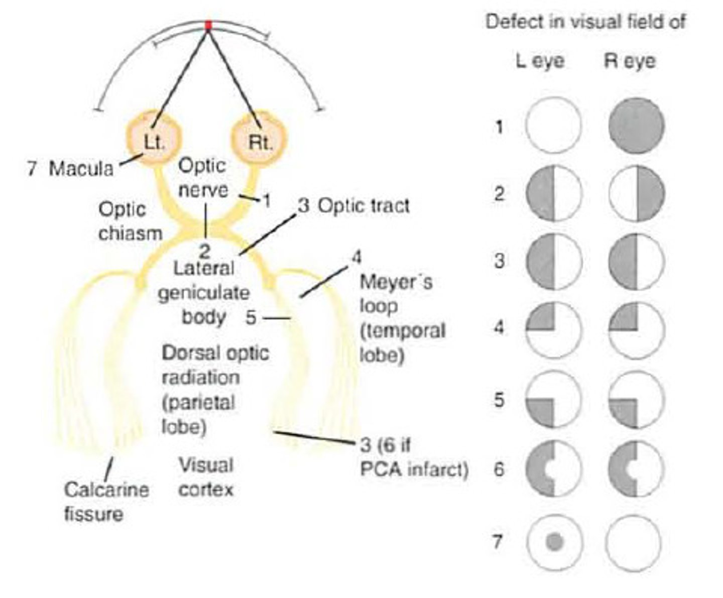 <p>total right eye blindness</p>