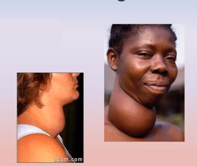<p><span>What is there a lack of to produce the condition known as Goiter?</span></p>