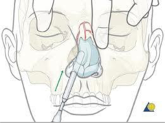 <p>Ice & head elevation</p><p>Displaced fractures: ENT consult (may require closed reduction)</p><p>Nasal splint (may be internal or external to provide support)</p>