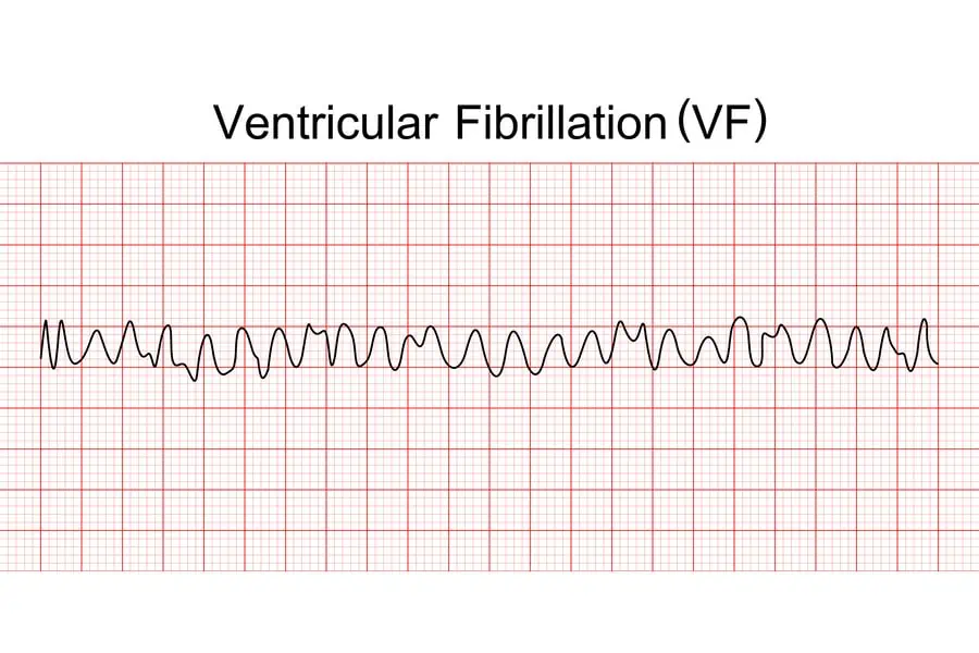 <ul><li><p><strong>a life-threatening heart rhythm emergency where the heart's lower chambers quiver chaotically instead of pumping, causing immediate loss of consciousness and cardiac arrest</strong><span>. </span></p></li><li><p><span>It requires instant CPR and electrical defibrillation to prevent death. </span></p></li><li><p><span>It is often caused by heart attacks, heart disease, or severe electrolyte imbalances</span></p></li></ul><p></p>