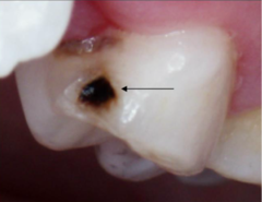 <p>What ICDAS score would be given to this tooth?</p>