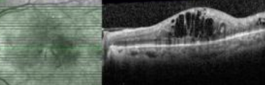 <p>classify the mac edema:</p>