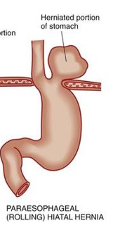 <p>para-esophageal hiatal hernia </p>