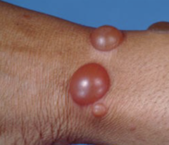 <p>Loss of Adhesion; autoantibodies form to antigens beneath the basal layer of the epidermis so epidermis forms roof of blister and dermis forms base of the blister</p><p>IgG autoantibodies bind to antigens that comprise the hemidesmosome adhesion complex in the basement membrane of the skin</p>