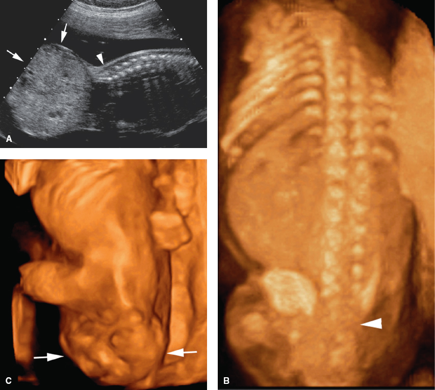 <p>Complex mass extending from the distal fetal spine</p><p>Mass can be highly vascular</p><p>Hydronephrosis may be present (when mass invades the pelvis)</p><p>Fetal hydrops may be present</p><p>Cardiomegaly</p>