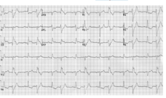 <p>- ir ekstrasistoles</p><p>- V5-V6 negatīvāks - līdz ar to kreisā k kompleksi</p>