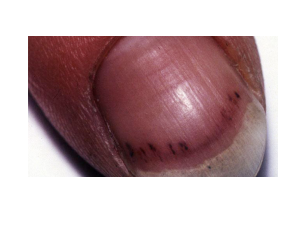 <p><mark data-color="blue" style="background-color: blue; color: inherit;">endothelial tissue</mark></p><p>normal endocard = smooth simple squamous epith</p><p></p><p>damaged to it = turbulent flow, defects, prosth valves</p><ul><li><p>exposes underlying tissue</p></li><li><p>lead to <strong>platelet + fibrin deposition</strong></p></li><li><p><strong>create surface for bacterial adherance > vegetation formation</strong></p></li></ul><p></p><p>abnormal tissue = simple squamous forms epithelial ridges/extension as the tissue break down > allow adhere of bact clusters</p><p></p><p><mark data-color="yellow" style="background-color: yellow; color: inherit;">symptoms of endocarditis</mark></p><ul><li><p>fever</p></li><li><p>malaise</p></li><li><p>weight loss</p></li><li><p>anemia</p></li><li><p>splinter haemorrhages</p></li></ul><p></p>