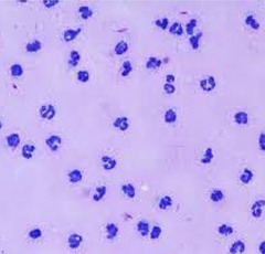 <p>This synovial fluid was taken from the carpus of a painful adult dog with a fever. </p><p>1. what are these cells</p><p>2. inflammatory or noninflammatory?</p><p>3. differentials?</p>