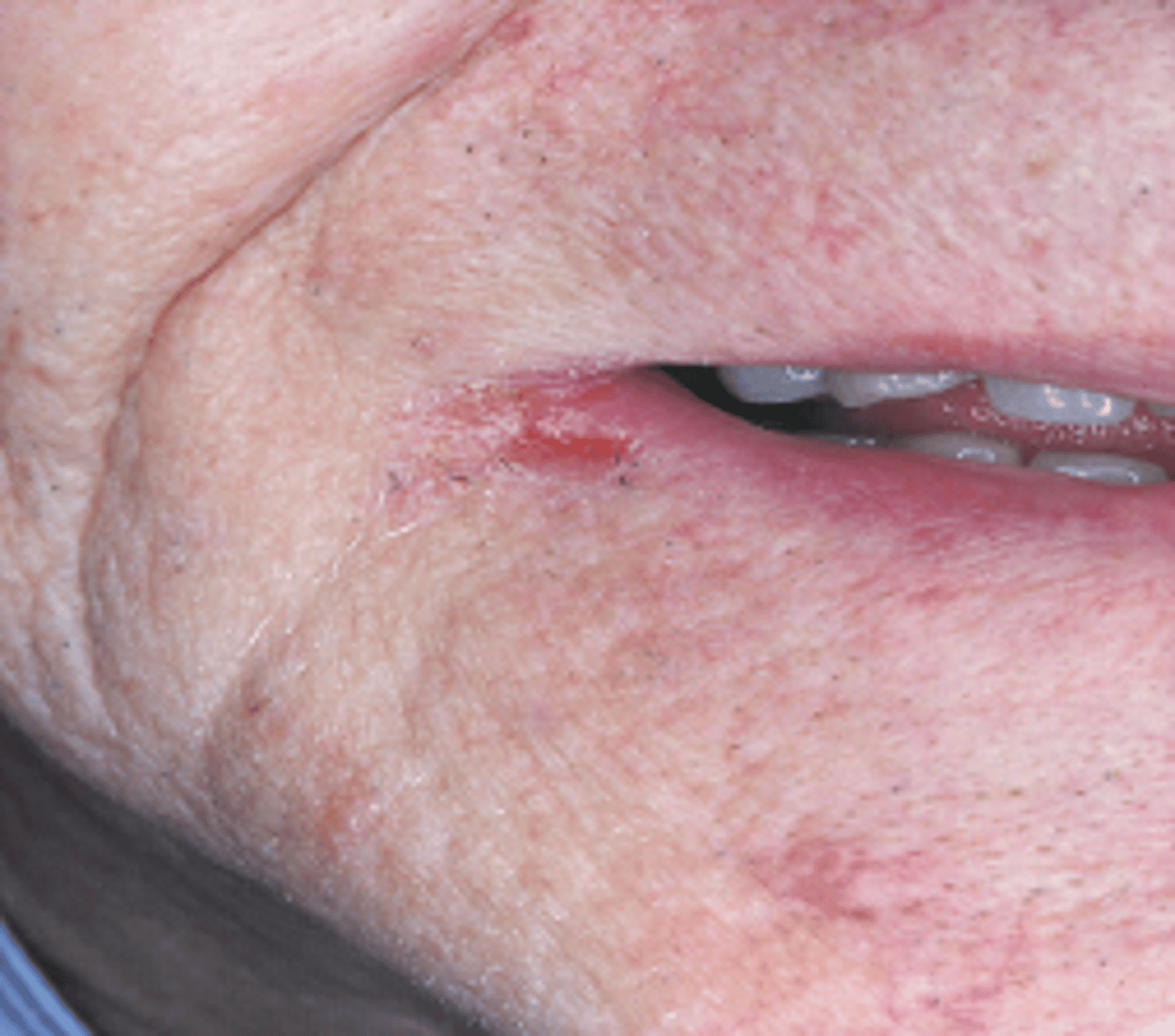 <p><br>-inflammation in corners of the mouth</p><p>-sore, swollen, cracked</p><p>This lesion in the commissure is most likely caused by Candida albicans or a nutritional deficiency.</p><p>Which condition do you suspect?</p>