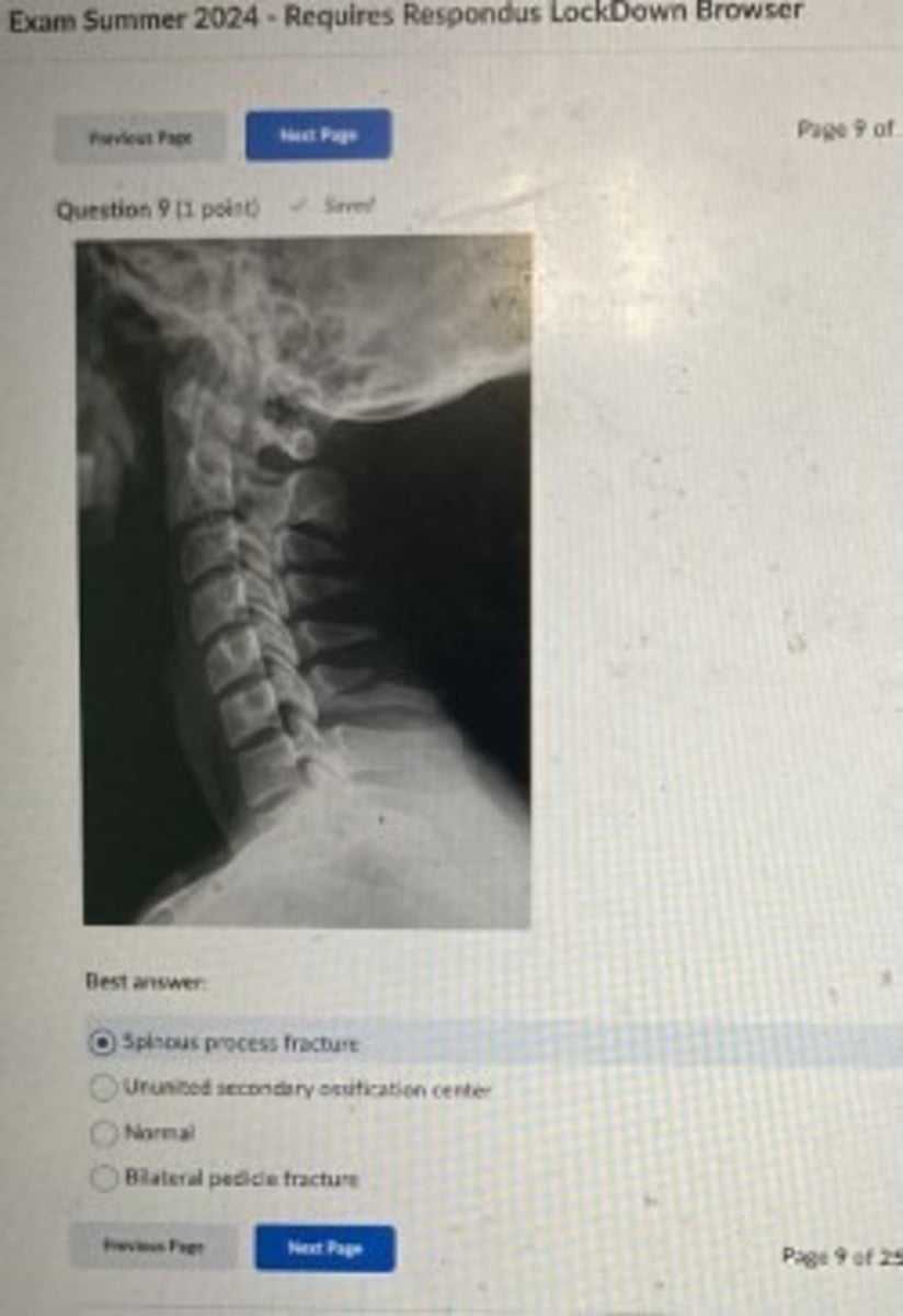 <p>spinous process fracture</p>