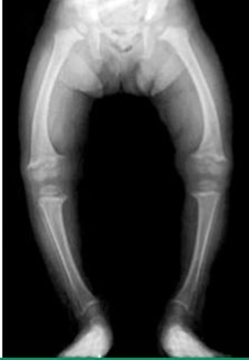 <p>Soft bones due to vitamin D deficiency; rickets in children.</p>
