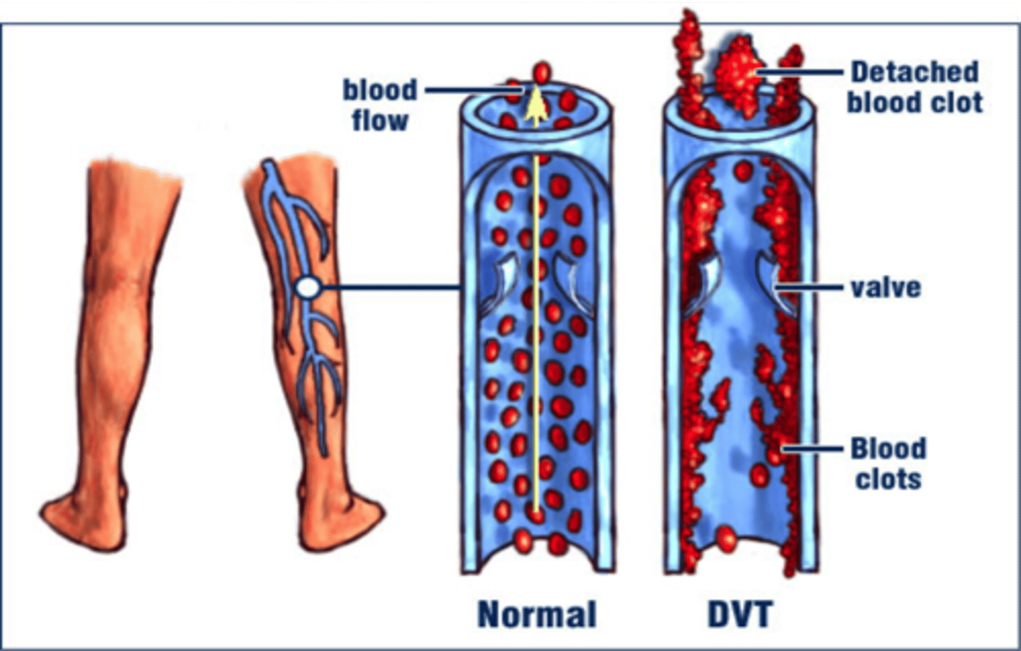 <p>inflammatory process, swelling, redness, heat, pain, happens from venastasis, pooling of blood in calf</p><p>-tachycardia, low grade temp</p><p>-women on birth control who smoke are at a higher risk, and also those who are dehydrated since blood is more viscous</p><p>-Do not perform homan's sign test (flexing foot back)</p>