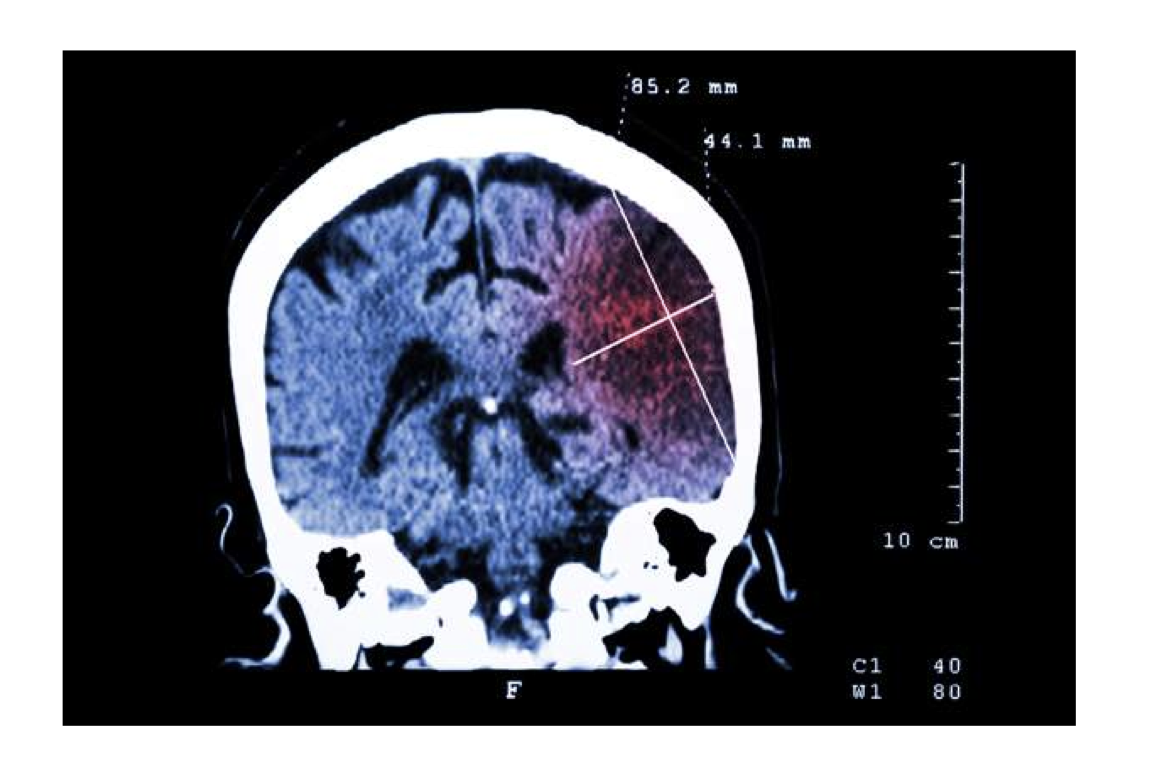 <p><span style="line-height: normal;">• </span>Aids in viewing of multiple, serial, and radiographic sections; produces detailed images of brain, spinal cord, and surrounding tissue</p><p class="p1"><span style="line-height: normal;">• </span>Uses magnetic fields and radio waves to produce detailed images of the brain and spinal cord</p>