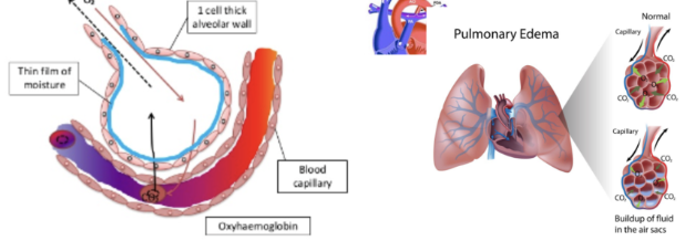 <p><span style="background-color: transparent;"><strong>Patent Ductus Arteriosis (<u>PDA</u>)</strong></span></p><ul><li><p><span style="background-color: transparent;"><strong>What if DA is not closed</strong>?</span></p><ul><li><p><span style="background-color: transparent;"><strong>PDA</strong></span></p><ul><li><p><span style="background-color: transparent;"><strong>_______</strong></span></p><ul><li><p><span style="background-color: transparent;">Aorta PA and lungs&nbsp;pulmonary over-circulation pulmonary edema reduced gas exchange&nbsp; reduced oxygenation</span></p></li></ul></li><li><p><span style="background-color: transparent;"><strong>_______</strong></span></p><ul><li><p><span style="background-color: transparent;"><strong>Pulmonary _______ and _______</strong></span></p></li></ul></li></ul></li></ul></li></ul><p></p>