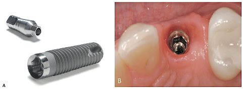 <p><span>is the implant component placed within bone</span></p>