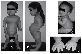 <p>Autosomal dominant: Dwarfism associated with defects in growth regions of long bones.</p>