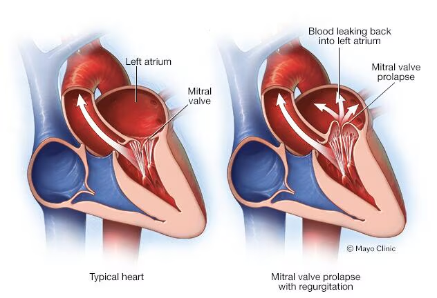 <p>3d Apex, Late Systolic murmur </p><p><span data-name="arrow_right" data-type="emoji">➡</span> Mitral Regurgitaion due to MVP (Mitral Valve Prolapse)</p>