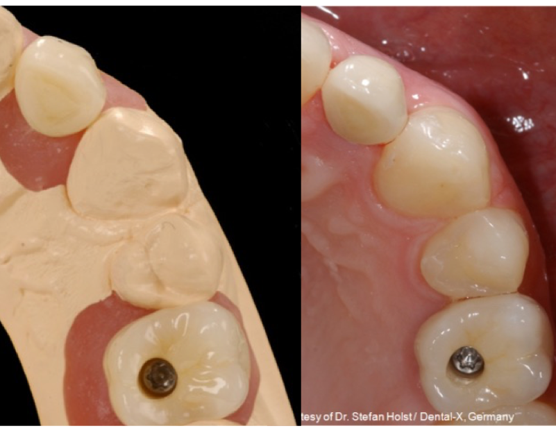 <p>Soft tissue cast</p>