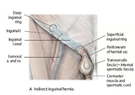 <p>indirect inguinal hernias </p>