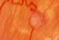 <p>Retinal hemangioblastomas occurring in von Hippel Lindau disease occur in the _____ retinal</p>