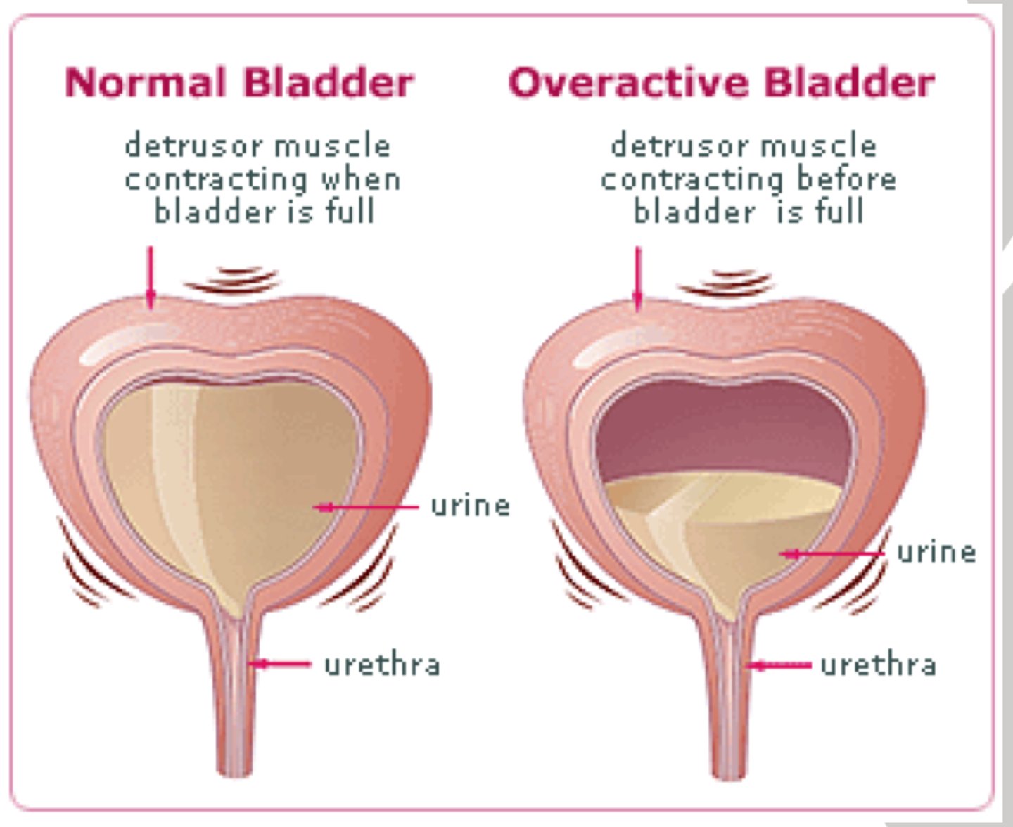 <p>- bladder is overactive/ detrusor is contracting (M3)</p><p>urgency, frequency, nocturia</p>