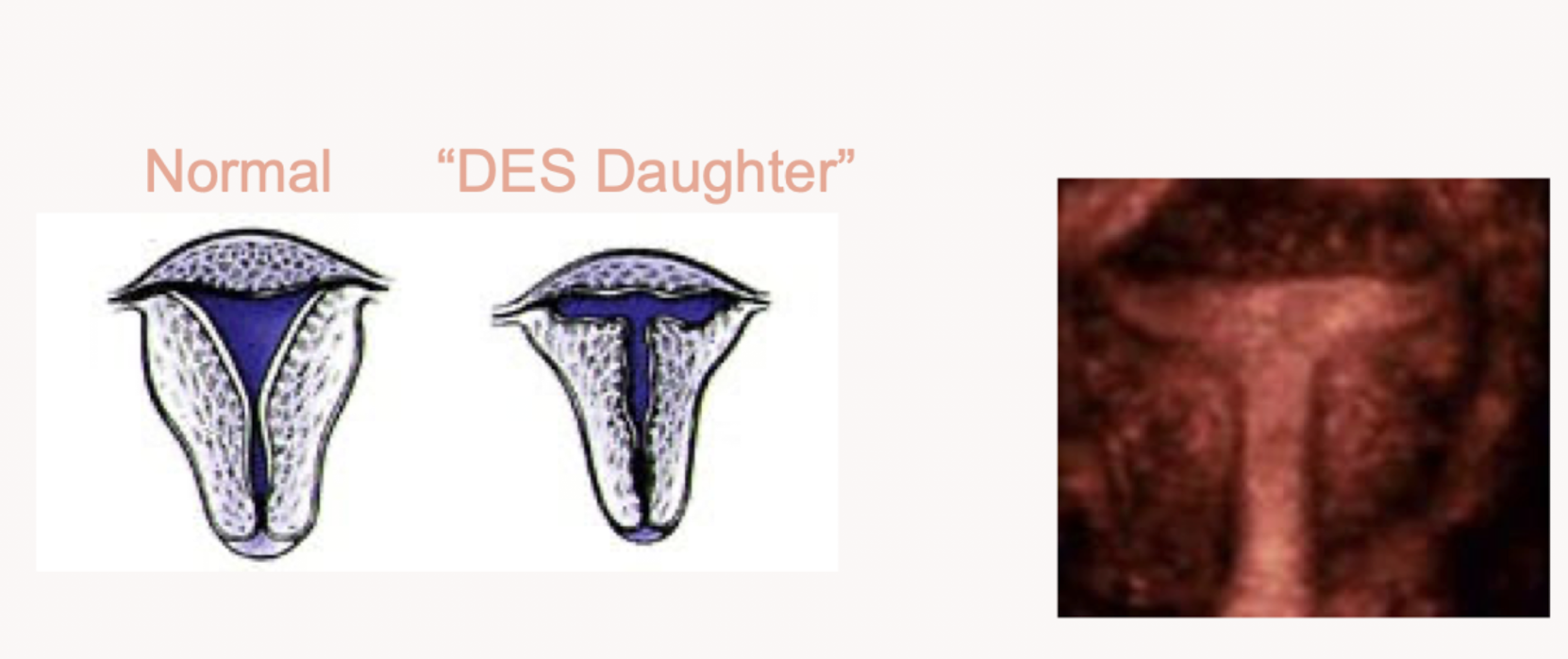 <p>T shaped uterus</p>