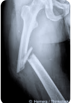<p>Fracture </p>