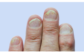 <p>What is this disease?</p>