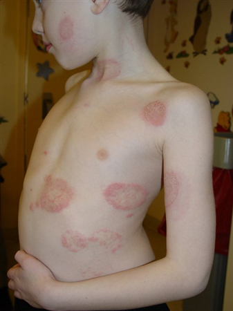 <p>A fungal skin infection commonly known as ringworm, characterized by circular, red, itchy patches with clear centers. </p>