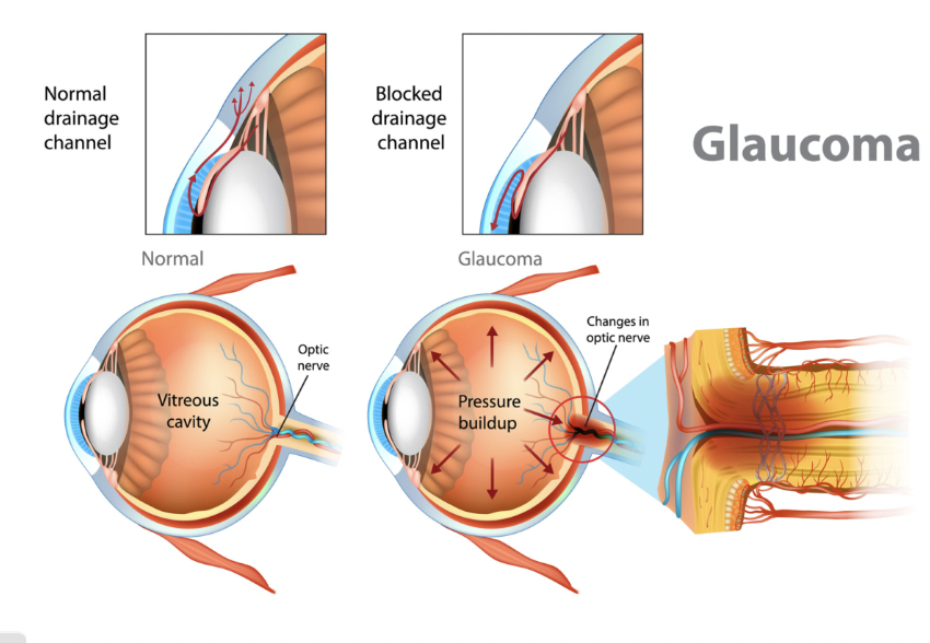 <p>How does Carbonic Anhydrase Inhibitors work on Glaucoma?</p>