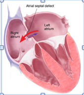 <p>An atrial septal defect initially presents with a left-to-right shunt</p>