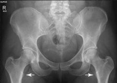 <p>How is the femur rotated?</p>