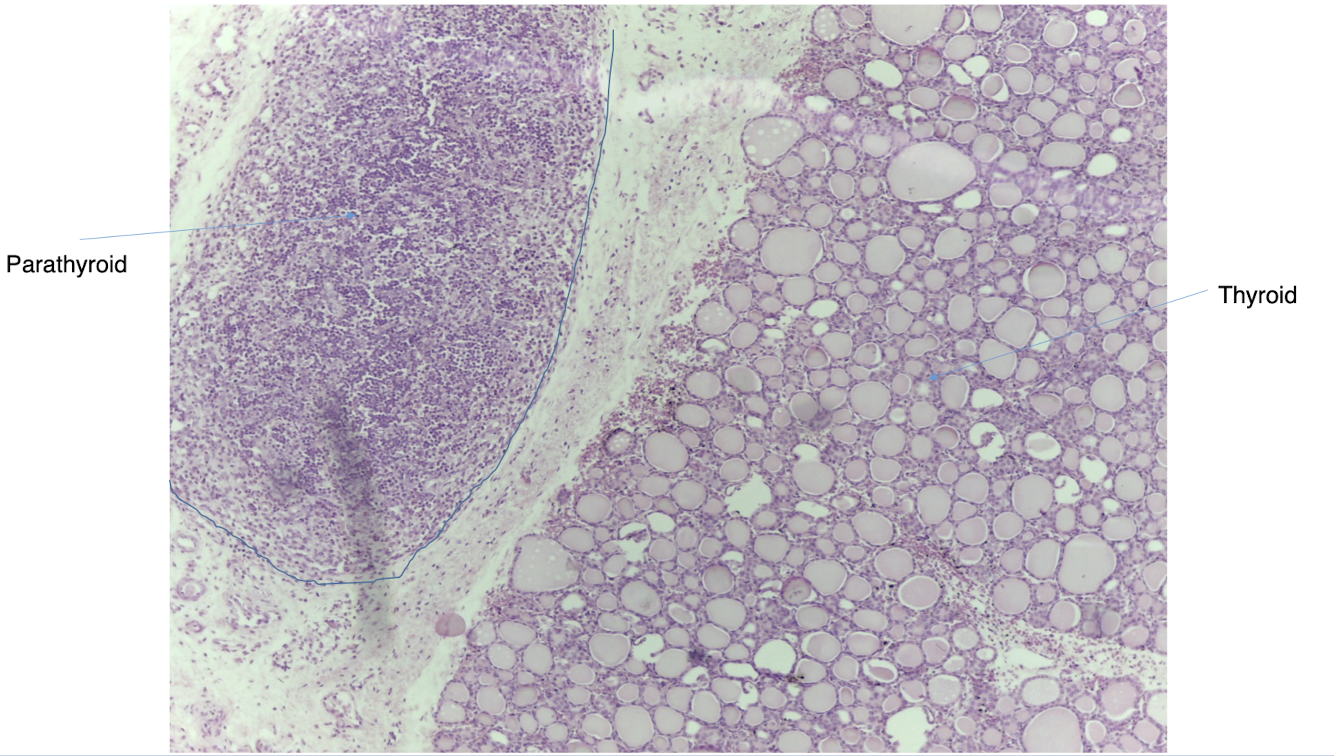 <p><span style="line-height: 19.55px;">dense and dark stained tissue at the edge of the thyroid&nbsp;</span></p>
