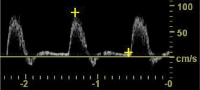 <p>The waveform shown in Figure 4–47 is</p><p class="p1">(A) Monophasic</p><p class="p1">(B) Biphasic</p><p class="p1">(C) Triphasic</p><p class="p1">(D) Preocclusive</p>
