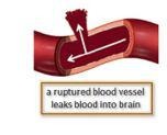 <p>Ruptured blood vessels leak blood into brain.</p>