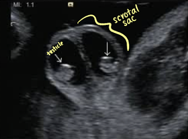 <ul><li><p>accumulation of serous fluid surrounding testicle, resulting from communication with peritoneal cavity</p></li><li><p>SONO: simple or complex</p></li></ul><p></p>