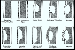 <p>These are the several types of periosteal reactions that can occur with bone lesions. Which of these periosteal reactions would be characterized as more aggressive because the lesion is growing SO fast it will not be "regular"?</p>