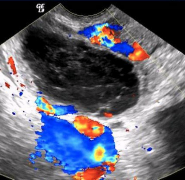 <p>This is an avascular mass w/ fibrin stranding. Dx?</p><p>a. Mature teratoma (dermoid)</p><p>b. Fibroma</p><p>c. Hemorrhagic cyst</p><p>d. Mucinous cystadenoma</p>