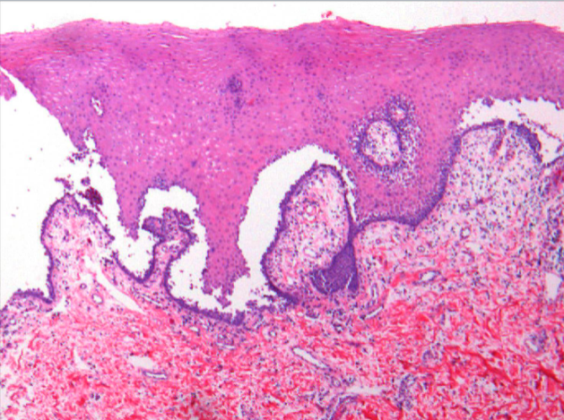 <p>Histopathologic Features of what condition?</p><p>• Perilesional tissue required for diagnosis</p><p>• Intraepithelial separation above basal layer (SUPRA-basilar cleavage)</p><p>• Acantholysis of spinous layer</p><p>• Rounded Tzanck cells</p><p>• Generally positive with direct or indirect immunofluorescence</p>