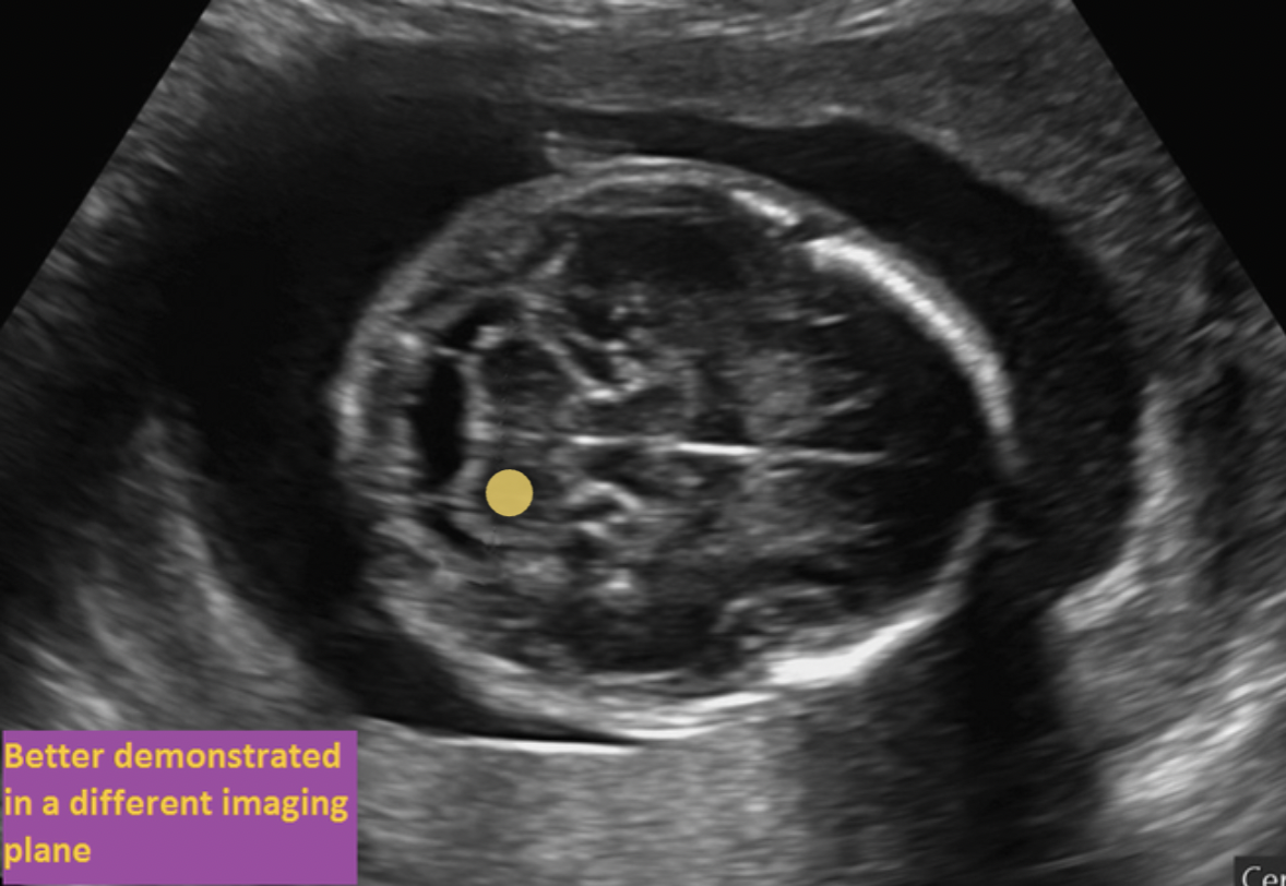 <p>The fetus is in breech position and facing the maternal left side. The fetal right side is anterior and the fetal left side is posterior on the image. The cerebellum has two lobes and appears as a dumbbell shaped structure in the posterior cranium.</p>
