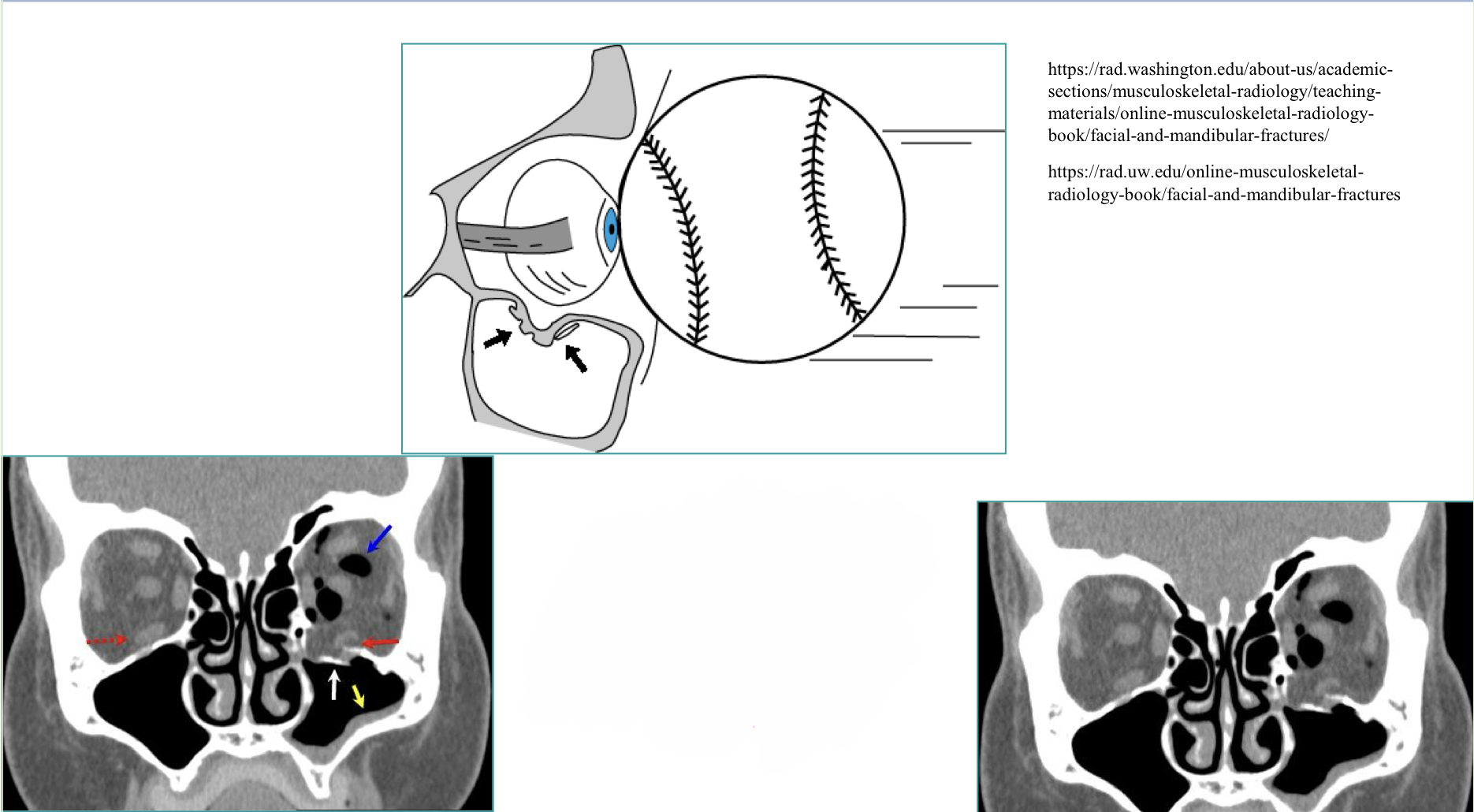 <p>What type of skull fracture is this</p>
