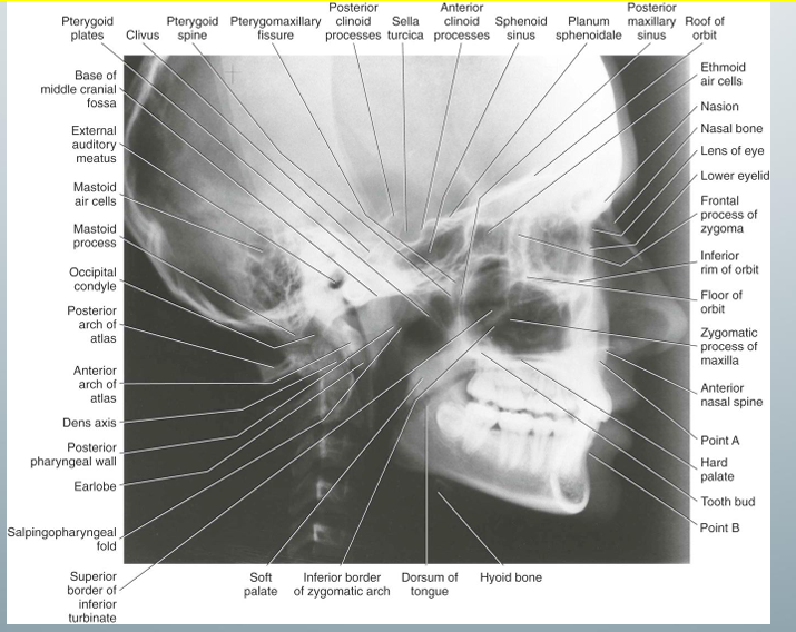 <p>-ortho use for treatment planning</p><p>-need soft tissue shadow for orthognathic measurement analysis^</p><p>-an aluminum wedge filter is set up at the tube head and absorbs some of the radiation to allow visualization of facial soft tissues</p>