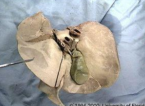 <p>what lobe of the liver is this?</p>