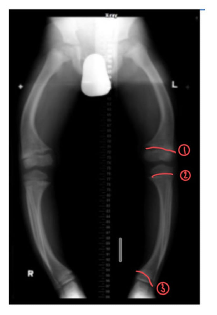 <p>The following x-ray shows a child diagnosed with rickets. Identify the three areas where you can see the epiphyseal growth plate</p>