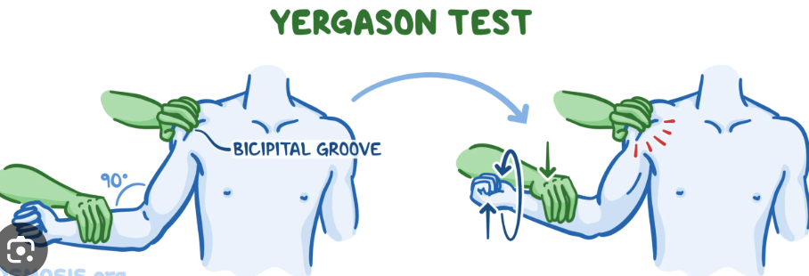 <p><strong>biceps tendon subluxation</strong></p><p><span style="background-color: transparent;">have patient sitting or standing</span></p><p><span style="background-color: transparent;">flex elbow to 90 degrees and pronate arm</span></p><p><span style="background-color: transparent;">tell patient to try to bring palm up to celling</span></p><p><span style="background-color: transparent;">palpate the biceps tendon/ bicipital groove</span></p><p><span style="background-color: transparent;">positive if: reproduction of symptoms inside the bicipital groove</span></p>
